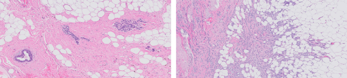 Breast Cancer: The tumor forms fibrous structures and small clusters that grow irregularly into the stroma (the connective tissue network of the tumor) and fat. Healthy Tissue: Within the connective tissue, regular milk ducts and lobules (glandular segments) are observed. Images: Fimlab